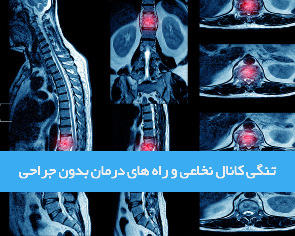 تنگی کانال نخاعی ، درمان غیر جراحی و جراحی