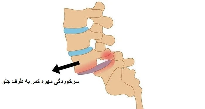 سرخوردگی مهره‌های کمر (اسپوندیلولیستزی) درمان قطعی دارد؟