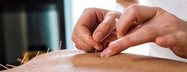 فواید و عوارض طب سوزنی برای لاغری، کمر درد و اعصاب