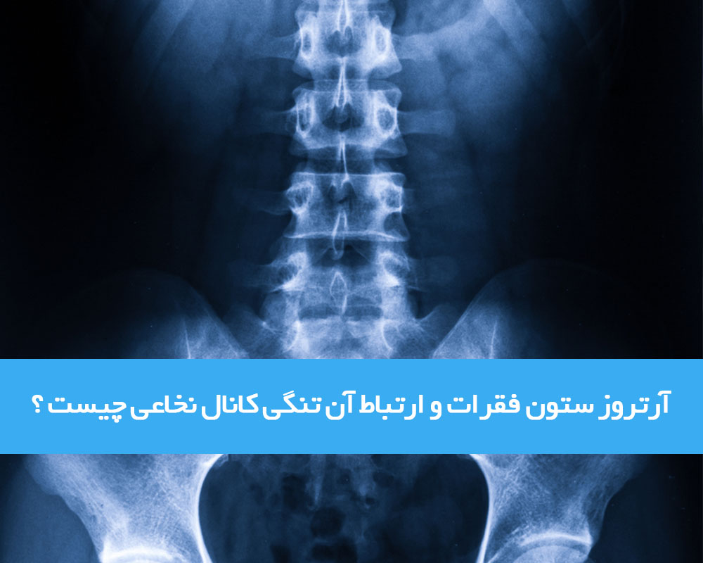 آرتروز ستون فقرات چیست و با تنگی کانال نخاعی و کمردرد چه ارتباطی دارد؟