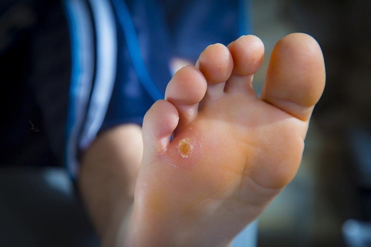 میخچه پا از چیست و چگونه از بین میرود؟ (سنگ پا، پماد، کفش مناسب و ...)