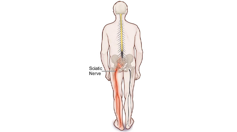 سیاتیک