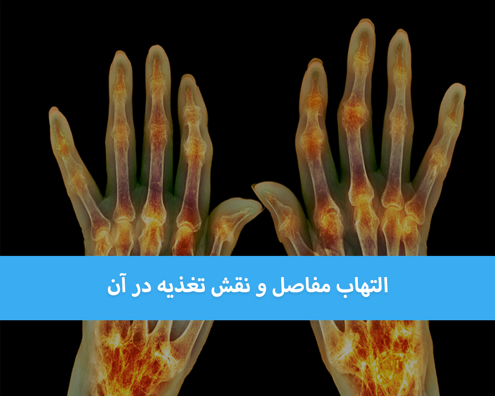 التهاب مفاصل و نقش تغذیه در آن