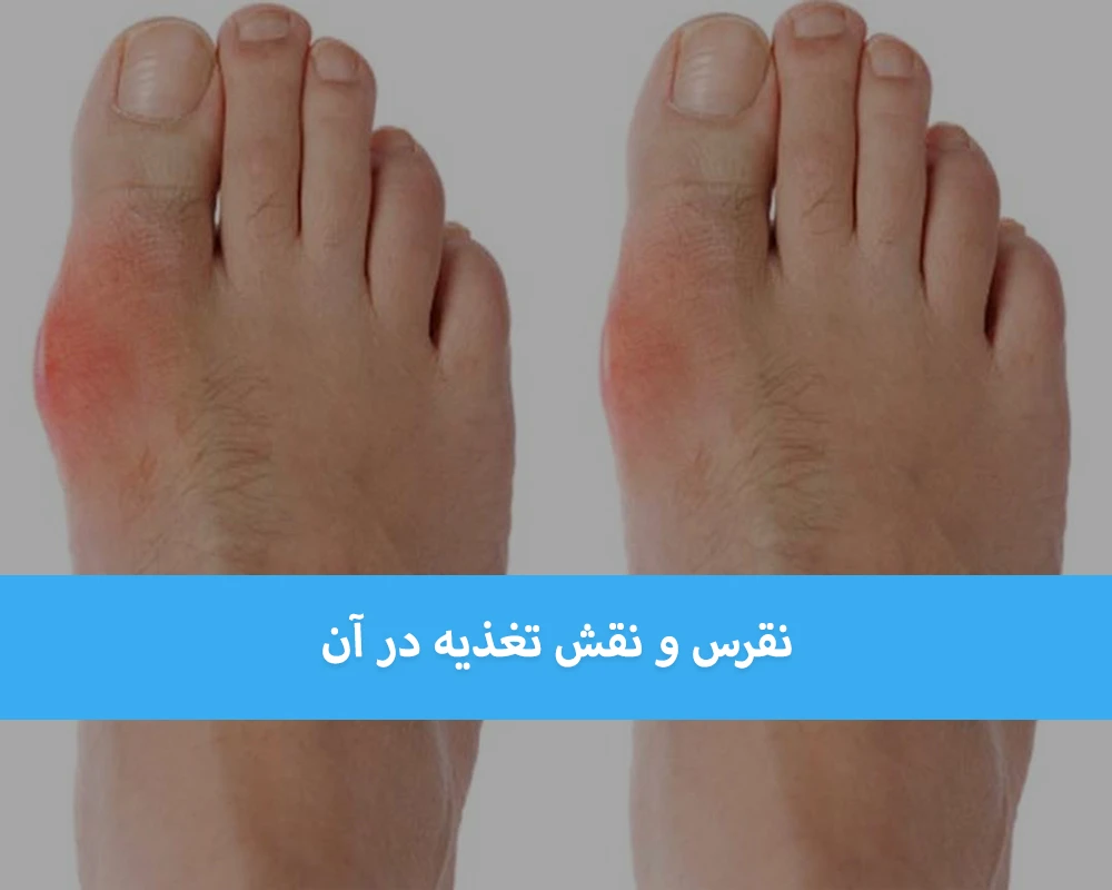 علائم بیماری نقرس چیست و تغذیه چه نقشی در درمان آن دارد؟