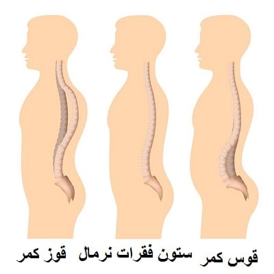 قوس کمر : بهترین راه درمان گودی کمر کودکان و بزرگسالان