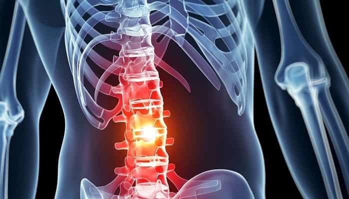 ضایعه نخاعی چه علائمی دارد؟ آیا آسیب نخاعی قابل درمان است؟