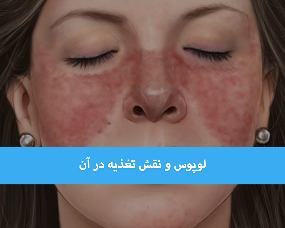بیماری لوپوس چه علائمی دارد و نقش تغذیه در آن چیست؟