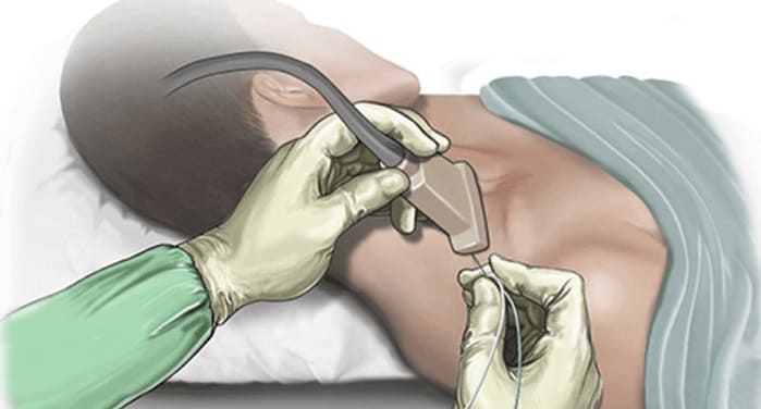 بلاک عصبی چیست؟ مراحل کاهش درد با عمل بلاک عصبی