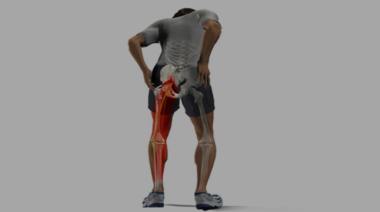 سندروم پیریفورمیس از علل مهم درد باسن و لگن چیست ؟