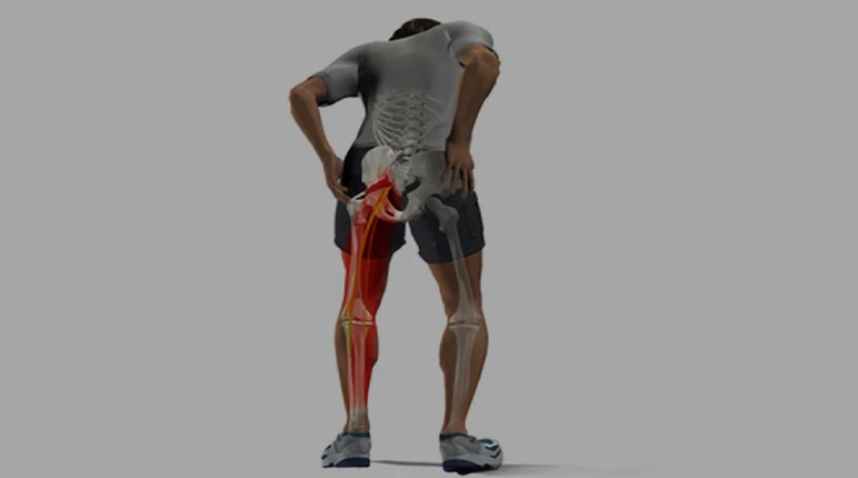 سندروم پیریفورمیس از علل مهم درد باسن و لگن چیست ؟