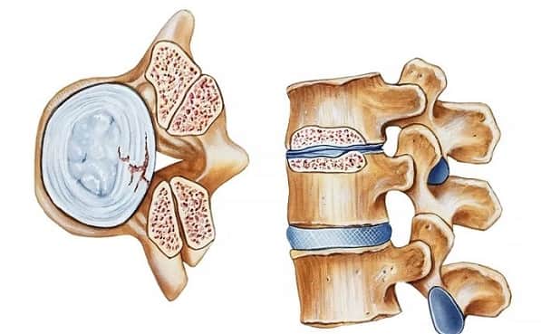 درمان تنگی کانال نخاعی کمر و گردن با روش های غیرجراحی