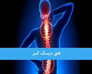 فتق دیسک