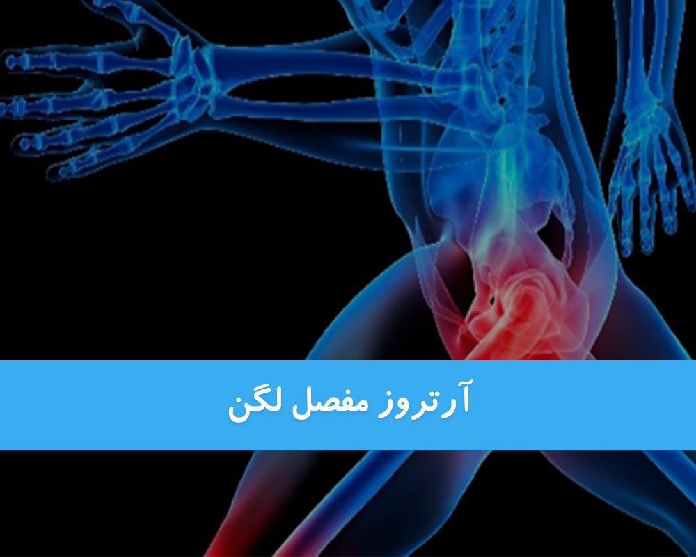 آرتروز لگن