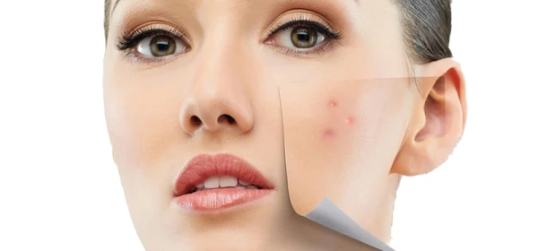 توصیه های تغذیه ای برای از بین بردن جوش صورت