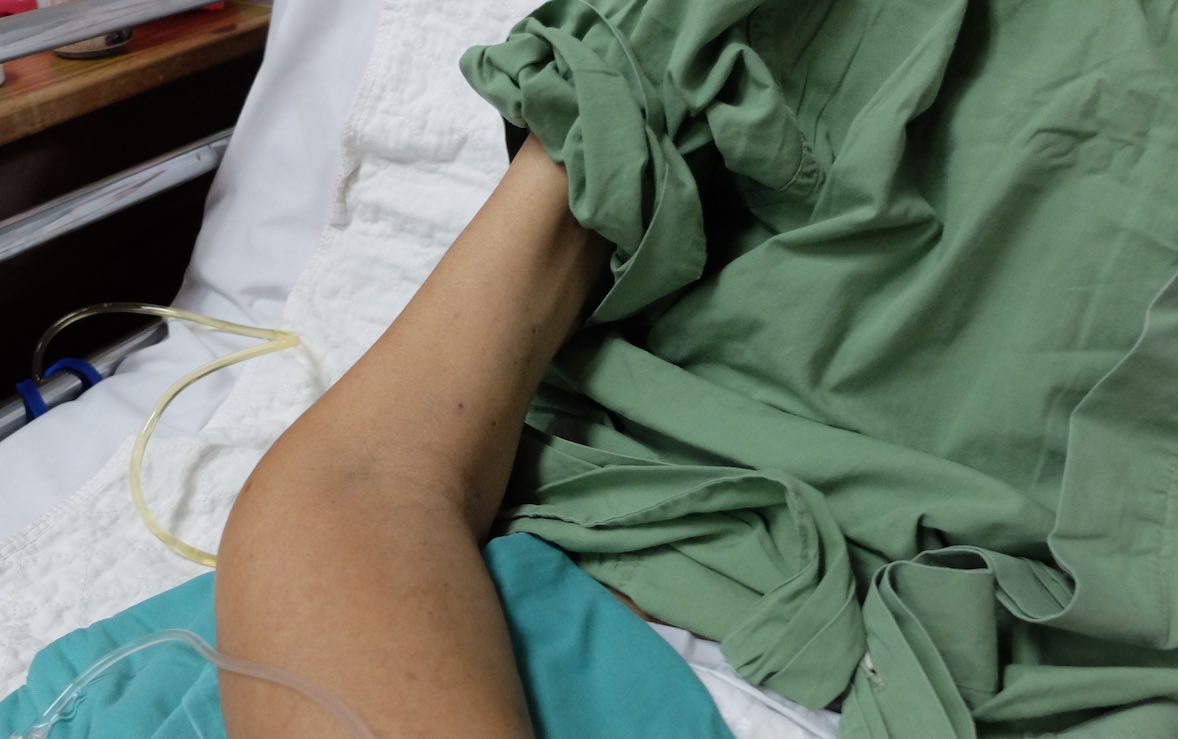 کاشکسیا یا لاغری مفرط (Cachexia)