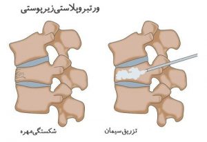پوکی استخوان