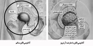 آرتروز مفصل لگن