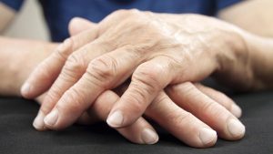 تغذیه و التهاب مفصل