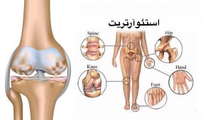 تغذیه و التهاب مفصل