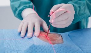 جراحی بسته فتق دیسک