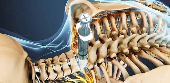تزریقات استروئید برای درمان آرتروز گردن