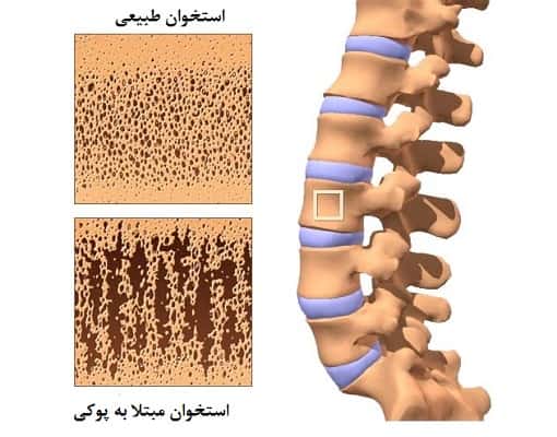آزمایش سنجش تراکم استخوان چیست؟