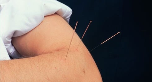 طب سوزنی برای درمان تنیس البو