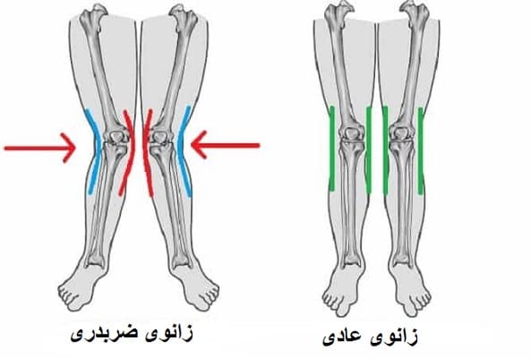 علائم زانوی ضربدری