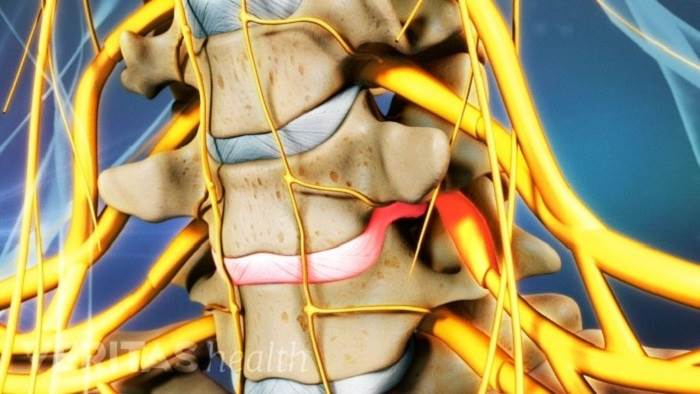 علائم پارگی دیسک گردن