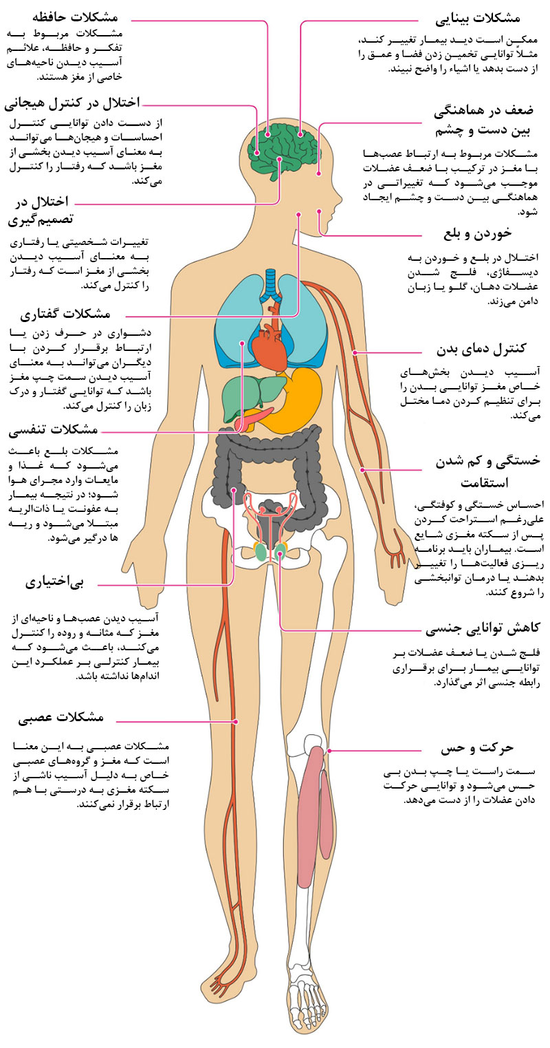 آثار سکته مغزی بر بدن انسان