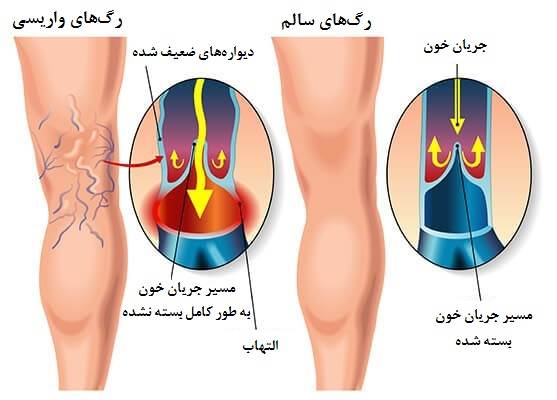 ایستادن طولانی مدت