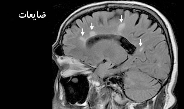 بررسی ضایعات اسکلروزیس چندگانه با MRI
