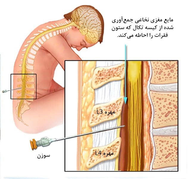 تشخیص ام اس از طریق پونکسیون کمری