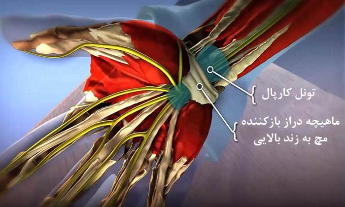 درمان سندروم تونل کارپال