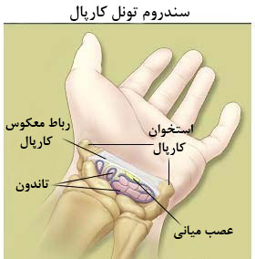سندورم-تونل-کارپال
