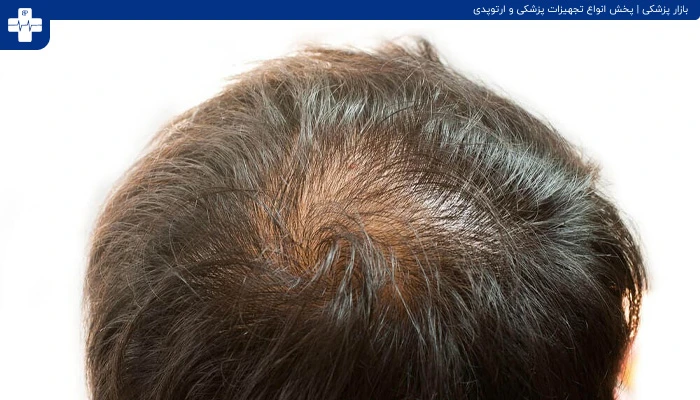 برای قطع ریزش مو چه مواد غذایی ای مصرف کنیم؟