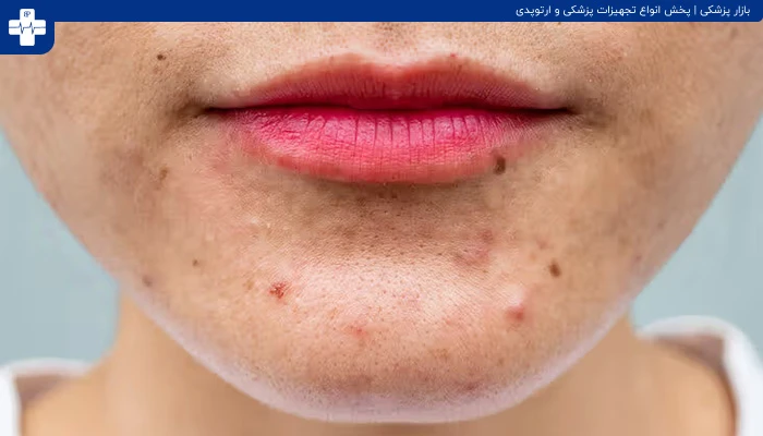 از بین بردن جوش صورت