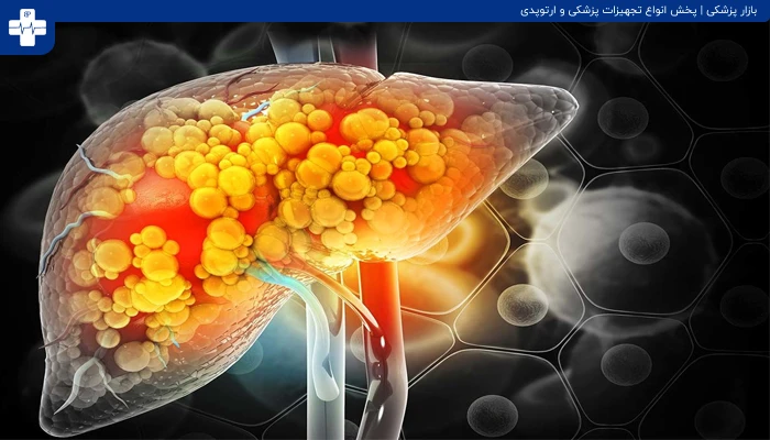 پیشگیری و درمان کبد چرب