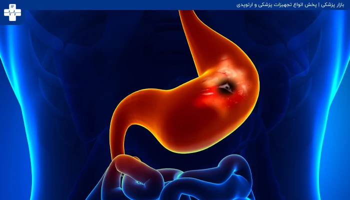 زخم معده
